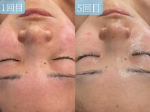 サロンドエテ(salon de ete)/ニキビケア、赤ら顔改善