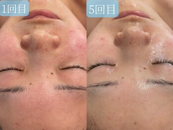 サロンドエテ(salon de ete)/ニキビケア、赤ら顔改善