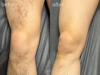 ボス 津店(BOSS)/【メンズ脱毛/足脱毛】