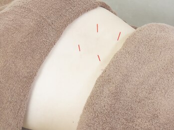 健康堂整骨院 公園通り院/急な腰痛にも鍼灸!