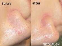 ニコラフ(Nico laugh)/リセットピーリング