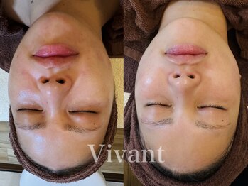 ヴィヴァンビー(Vivant+B)/before/after