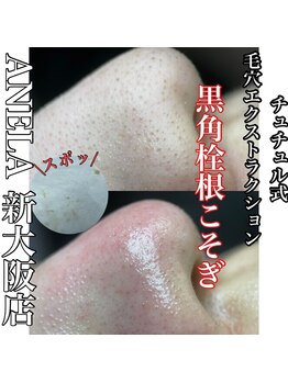 アネラ(ANELA)/毛穴エクストラクション　症例