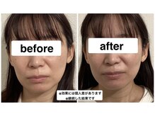 グリーン鍼灸整体院(green鍼灸整体院)/美容鍼