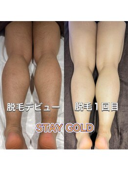 ステイゴールド 新百合ヶ丘(STAY GOLD)/足脱毛デビュー!続々と来店中