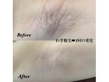 ジューンブライド(June Bride 61)/脇脱毛