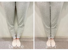 学芸大整体院/О脚×美脚矯正 / BeforeAfter
