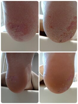 あし処 トコトコ(tocotoco)/ガサガサかかと