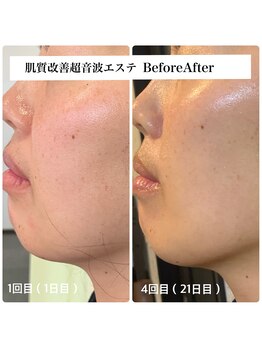 ルネ(Lune)/超音波(ソニックエステ)