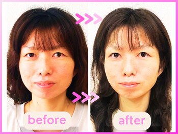 ホリハ整体院/*Before&After* 幹細胞美容鍼