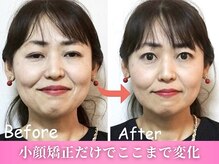 鍼灸整体院ワト 三軒茶屋院(鍼灸整体院WATO)/■小顔矯正（before→after）