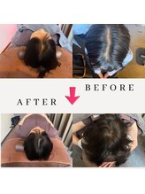 レメディ/グロスファクター育毛促進鍼