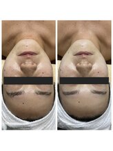 ランプ(LAMP)/～BBL光フェイシャル～