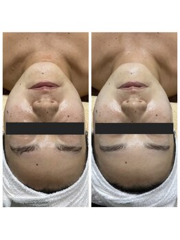 ランプ(LAMP)/~BBL光フェイシャル~