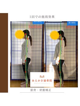 あらかき接骨院/【姿勢の変化】