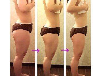 バービーホリック(barbie holic)/痩身　途中経過の変化　２０代