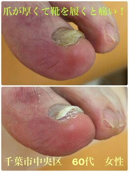巻き爪じゅん 船橋店/爪が厚くなった状態は肥厚爪！