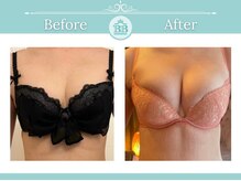 美人バスト 千早店/バストアップ◇育乳症例◇
