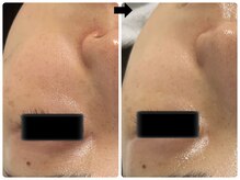 エフェクト 塚口店(effect)/Before After &nbsp;&nbsp;20代/2回目