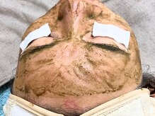 コンフィ(Comfy)/韓国ハーブピーリング