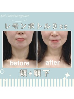 ハロ 南青山(HALO)/レモンボトル頬+顎下3cc