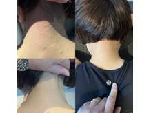 ハーモニーフィットネス 赤坂(Harmony Fitness)の雰囲気（施術1回の変化！首の骨の歪みが原因の発疹[赤坂/整体]）