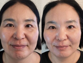 フリージア(Freesia)/【1】　ヒト幹細胞フェイシャル