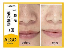 アルゴ 南茨木駅前店(ALGO)/【毛穴洗浄で汚れゴッソリ】