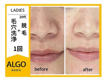 アルゴ 南茨木駅前店(ALGO)/【毛穴洗浄で汚れゴッソリ】