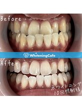 ホワイトニングカフェ 黒崎店(WhiteningCafe)/◎ホワイトニング症例写真◎