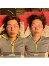美容整体サロン プライム(Prime)/小顔矯正　ビフォーアフター