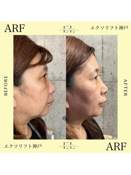 アーフ(ARF)/エクソリフト