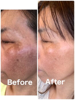 ゆるる(You*ruru)/シミケアで透き通る素肌へ