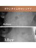 【シミでお悩みの方は必見！】まずはお試し！ダウンタイムゼロシミケア！