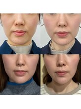 トゥインクル(Twinkle)/自然にどんどんリフトアップ！