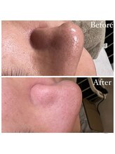 マドモアゼル 麻布十番/毛穴洗浄