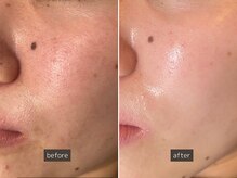 SEC(Shizuoka esthetic company)/【肌質改善】光フェイシャル肌育