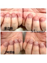 モアナ 池袋(MOANA)/人工爪深爪改善