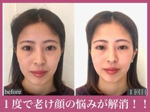 アクアビー(AQUA-B)/歪み・面長改善例【金剛/小顔】