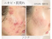 スリースリー(THREE THREE)/ニキビ・肌荒れケア