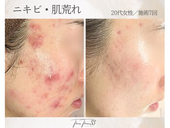 スリースリー(THREE THREE)/ニキビ・肌荒れケア