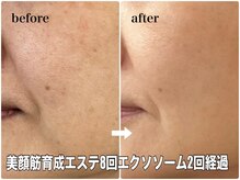 リエル(RIEL)/小顔矯正×美顔筋育成エステ