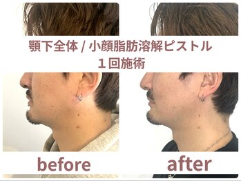 サボラミ(sabor A Mi)/顎下全体 脂肪分解ピストル