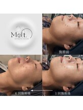 メルト 中目黒(Melt.)/◇サーマジェン
