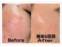 フィオーレの雰囲気（★美顔★NO5【サウナ＋毛穴＋ニキビケア】鼻黒ずみ・ビタミンＣ）