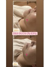 カラーリリー(calla lily)/ウルトラリフトプレミアム