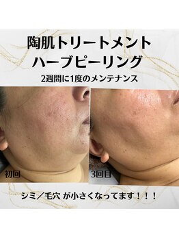 キラリ(Kirari)/陶肌トリートメントで美肌革命!