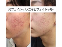 サロン ベル(Salon B'elle)/光フェイシャル(ニキビ用)