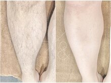 ランド 中目黒(L&)/脚脱毛（3回照射）