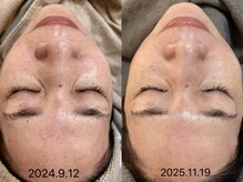 ビーマジック(Be Magic)/men'sも毛穴洗浄！